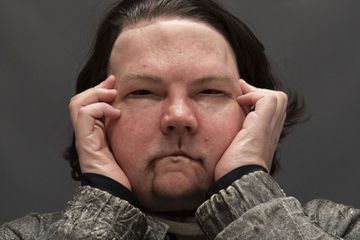 Triple greffe réussie du visage et des deux mains pour Joe DiMeo