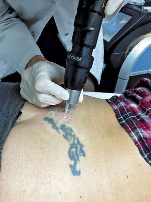 A Paris, le Dr Marie Jourdan est en train de retirer un tatouage avec le nouveau laser PicoSure