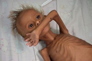Au Yémen, les enfants meurent de faim