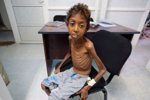 Un enfant de 8 ans au Yémen, touché par la famine. 