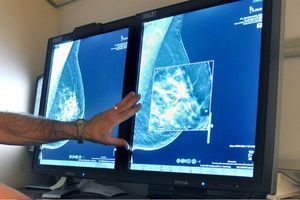 Un radiologue compare des mammographies 2D et 3D. La technologie de l'imagerie permet aujourd'hui de détecter de tous petits "cancers". 