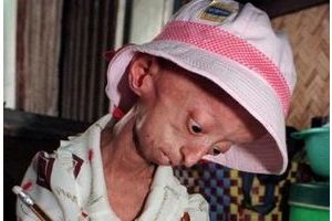  Jeune Vietnamienne âgée de 13 ans atteinte de la progeria (archives). 