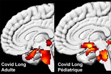Sur ces images réalisées par TEP métabolique dans le service du Pr Eric Guedj, des hypométabolismes cérébraux (régions limbiques et tronc cérébral) sont retrouvés dans le Covid long de l'adulte et de l'enfant.