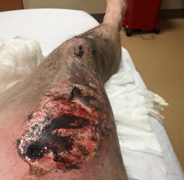Sa cigarette lectronique explose dans son pantalon - Etats-Unis