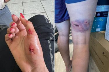 Deux points de suture à la main, un hématome et des plaies à l’arrière de la cuisse. Des photos prises par Kheira Hamraoui le soir de son agression, le 4 novembre 2021.