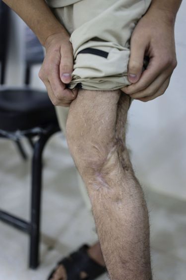 La jambe gauche d’Adem Clain, blessé par un tir de mortier à Baghouz.