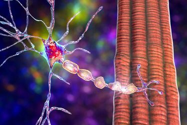 La sclérose en plaques est une maladie auto-immune du système nerveux central (cerveau et moelle épinière). Elle provoque un dérèglement du système immunitaire, qui s'attaque à la myéline (illustration), la gaine servant à protéger les fibres nerveuses. 