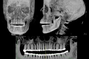 La radiographie de sa mâchoire révèle une dentition en très bon état.
