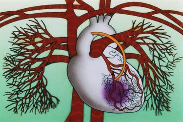 Le TAVI : quand la chirurgie aortique est trop risquée