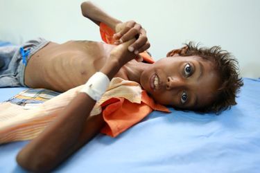 Imran Faraj, 8 ans, souffre de malnutrition, le 13 juin 2017.