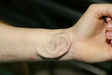 Pendant six mois, la patiente a gardé un greffon d'oreille sur l'avant-bras. 