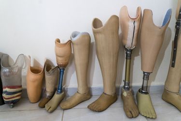 Des prothèses pour chaque âge de la vie.  Les mutilations touchent énormément d’enfants.