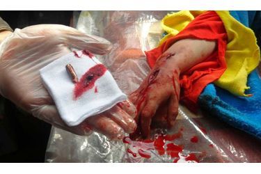 Un médecin a retirée une balle de la main d&#039;une fillette blessée au cours de ce que les manifestants présentent comme une attaque des forces du président syrien Bachar al-Assad, dans le quartier de Khalidiya à Homs.