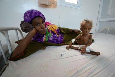 Un enfant yéménite malnutri photographié dans un hôpital de Houdieda, le 9 septembre 2016.