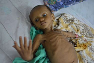 Un garçonnet yéménite malnutri photographié dans un hôpital de Sanaa, le 9 septembre 2016.