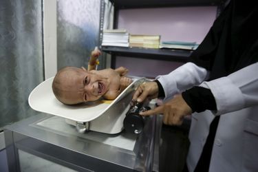 Une fillette yéménite malnutrie photographiée dans un hôpital de Sanaa, le 10 février 2016.