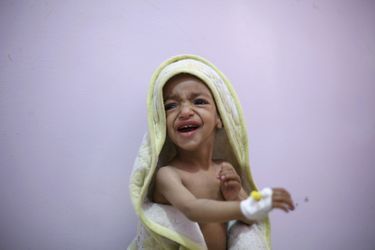 Un garçonnet yéménite malnutri photographié dans un hôpital de Sanaa, le 10 février 2016.