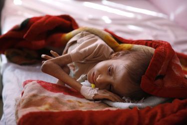 Un enfant yéménite malnutri photographié dans un hôpital de Sanaa, le 24 janvier 2016.