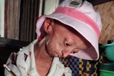 <br />
Jeune Vietnamienne âgée de 13 ans atteinte de la progeria (archives). 