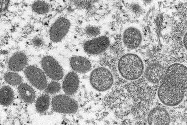 Une image au microscope électronique (EM) montre des particules de virus de la variole du singe.