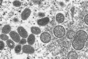 Le virus de la variole du singe présente des similitudes avec celui de la variole humaine, éradiqué depuis les années 1980, date à laquelle les campagnes de vaccination contre cette maladie ont cessé.