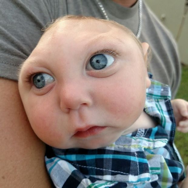 Atteint D Une Tres Grave Malformation Jaxon Le Bebe Qui Defie La Mort