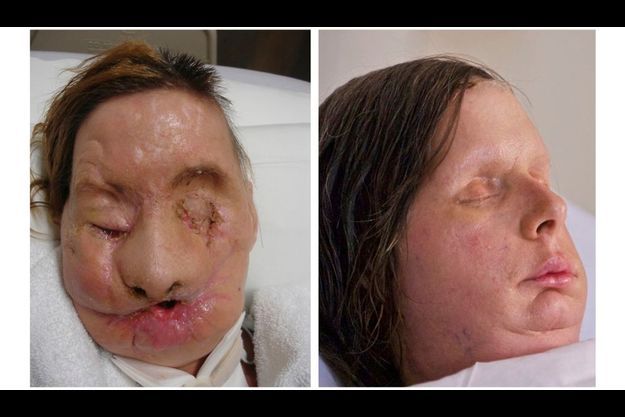 Defiguree Par Un Chimpanze Charla Retrouve Un Visage