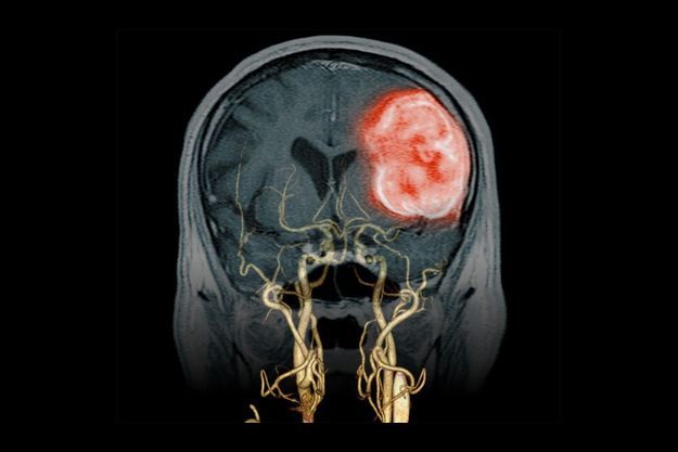  Un scanner des vaisseaux du cou associé à une IRM du crâne montrant un AVC hémorragique (en rouge). Image du Dr Didier Buthiau.