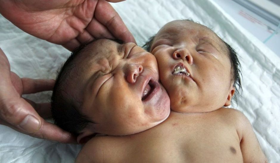 Chine Naissance D Un Bebe A Deux Tetes