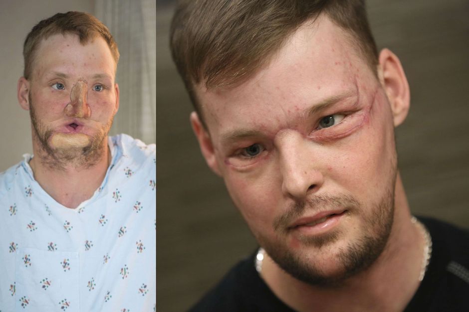 Andy Les Marseillais Au Mexique Origine Le résultat incroyable de la greffe de visage d’Andy